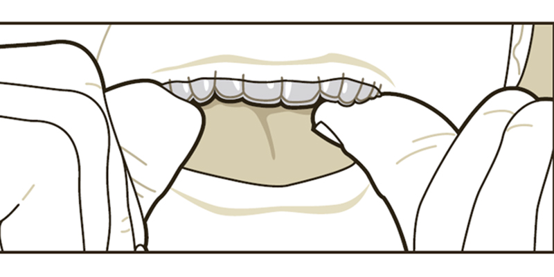 Handling Your Aligners