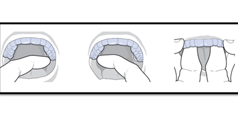 Handling Your Aligners